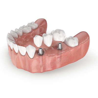 Implantes dentales