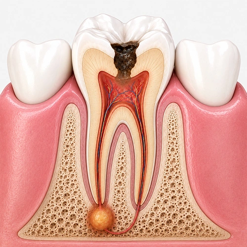 tratamiento-de-canal-clinica-dental-cerca-de-mi